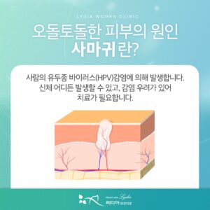 강남사마귀제거