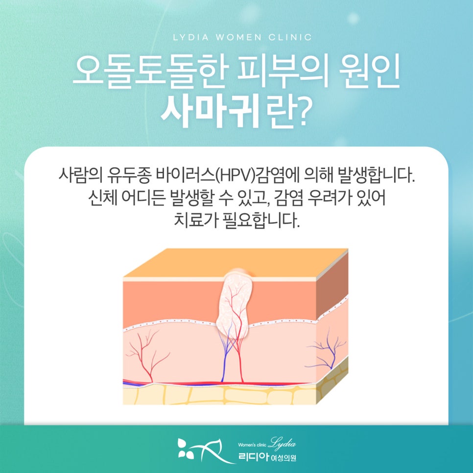 강남사마귀제거