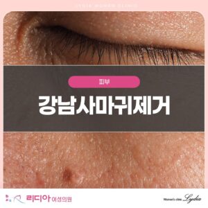 강남사마귀빼기