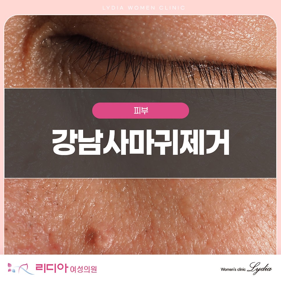 강남사마귀빼기