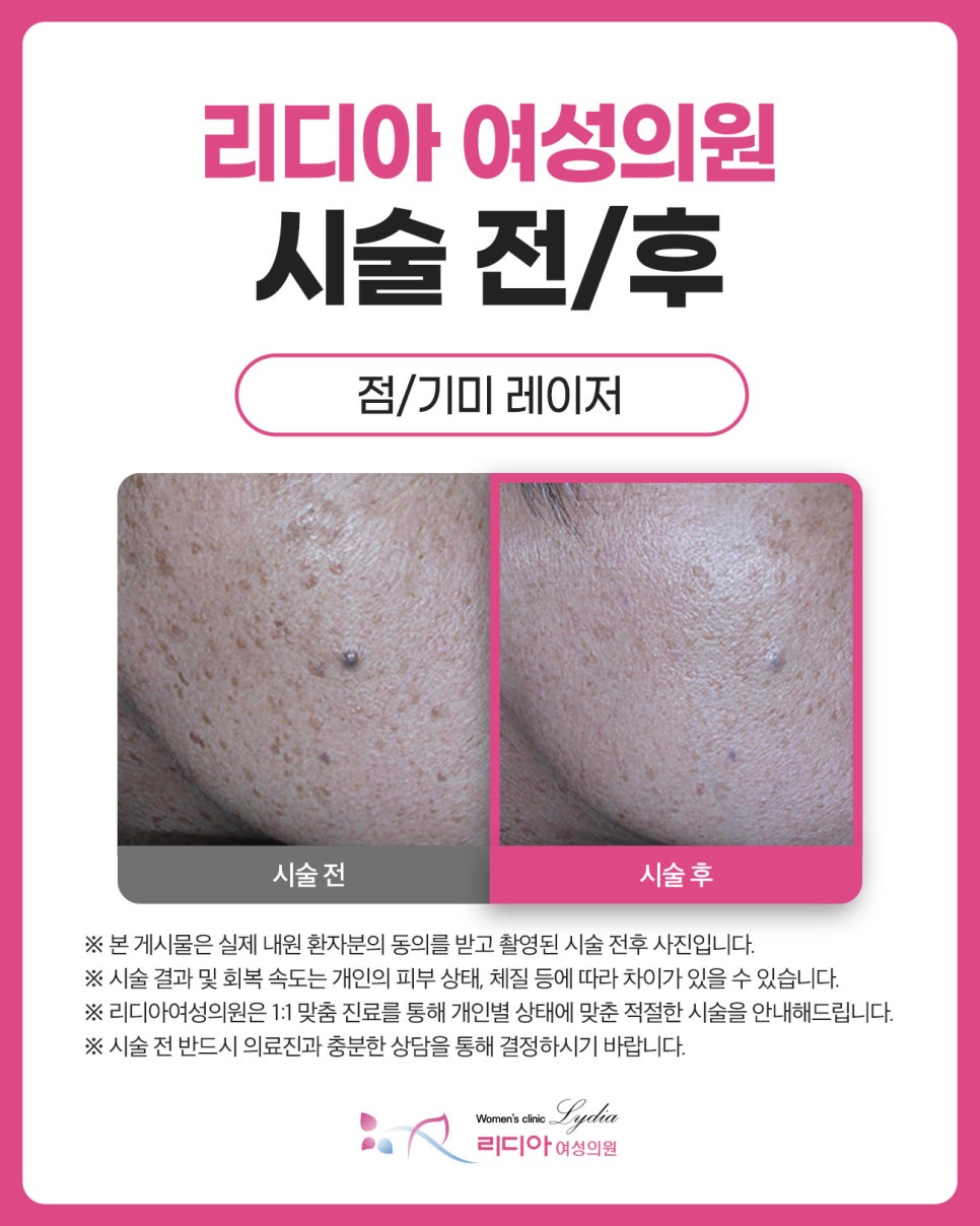 강남점빼기