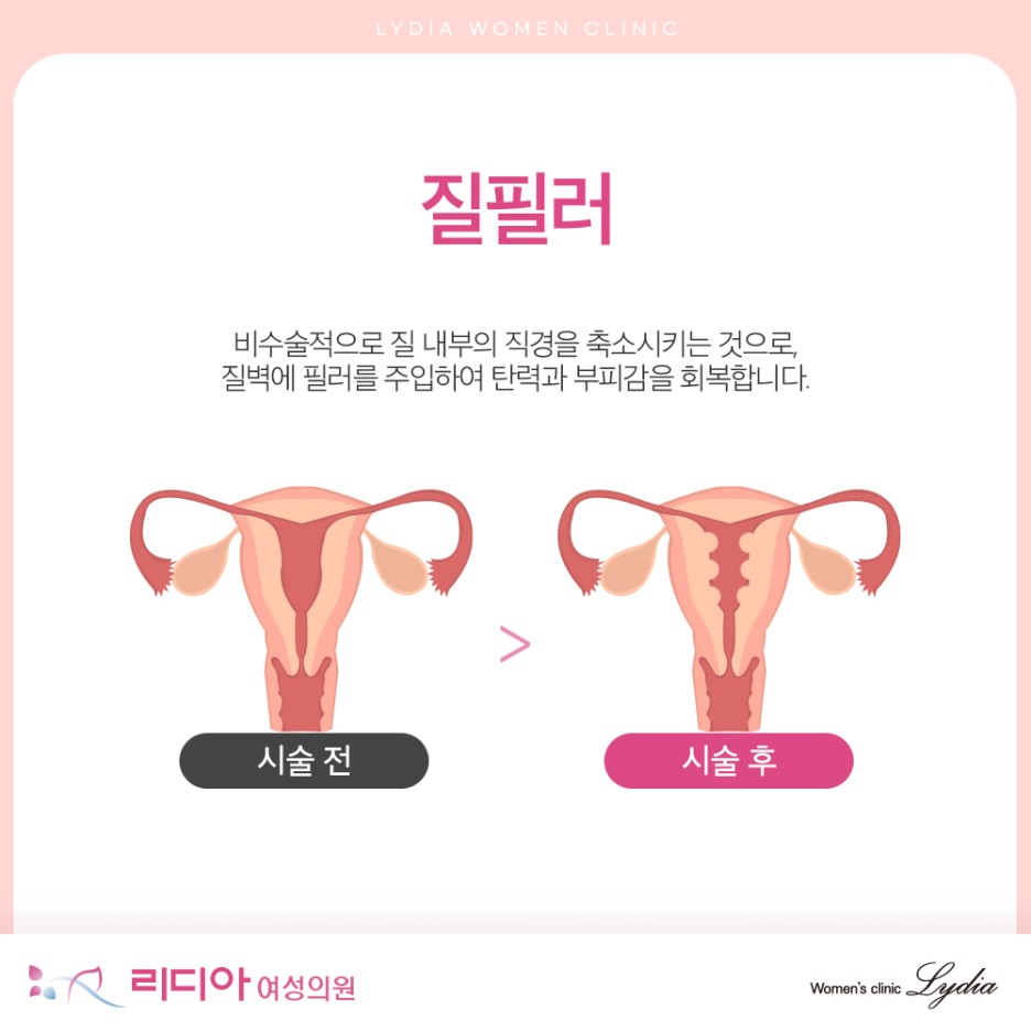 강남질필러 비용 가격 차이와 유지기간별 얼마인지 상담 전 확인해야 할 포인트