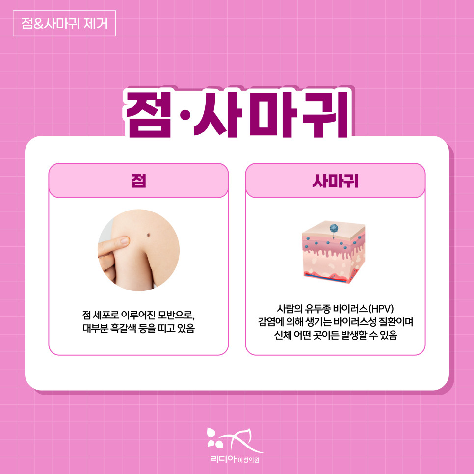 많은 점과 사마귀 제거 부담을 살피는 상담