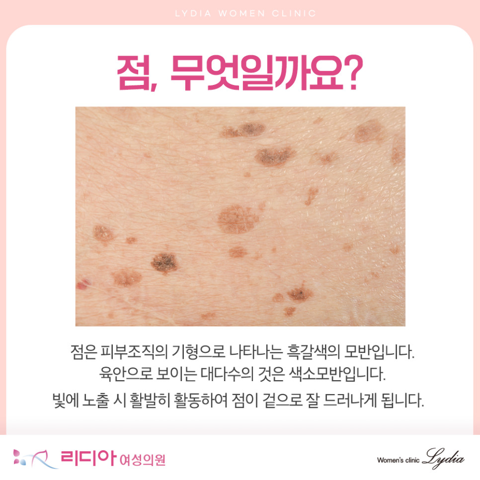 화장으로도 가려지기 어려운 얼굴 점 고민