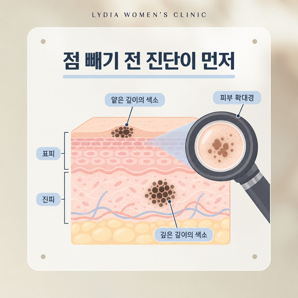 강남점빼기 전 색소성 병변 여부 확인하는 피부과 진단 단계