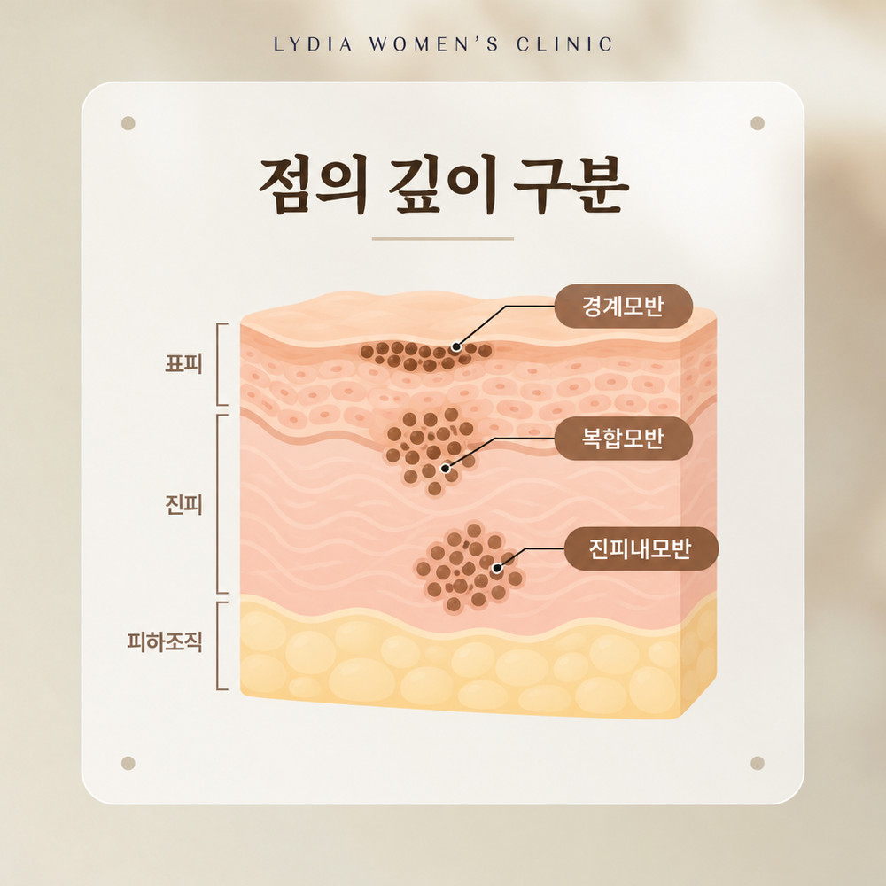 점이 표피에서 진피층까지 옮겨 가는 깊이 구분 기준
