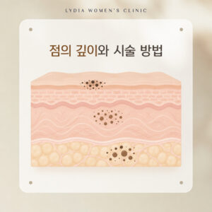 강남점빼기-점깊이-맞춤-시술