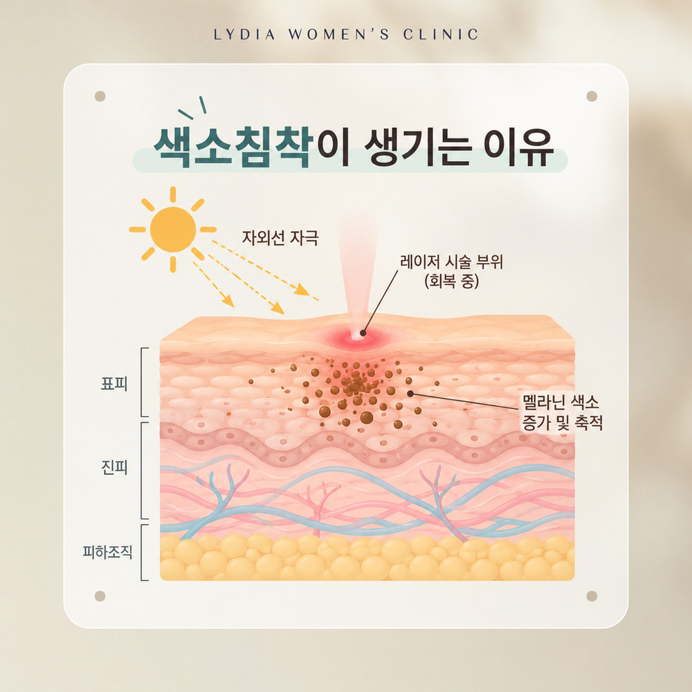 레이저 상처가 아물며 멜라닌이 늘어 시술 자리가 갈색으로 짙어지는 원리